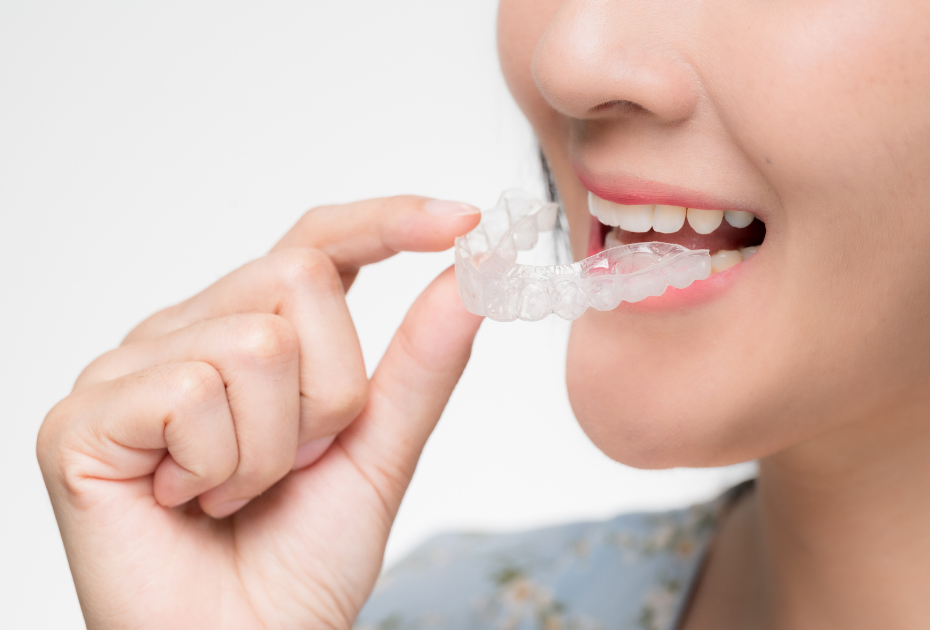 Top 10 Benefits of Clear Aligners for New Zealand Patients in 2025