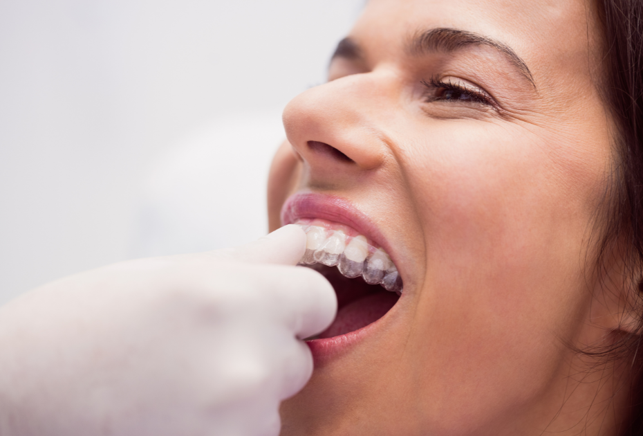 Invisible Braces Cost in New Zealand: What to Expect in 2025