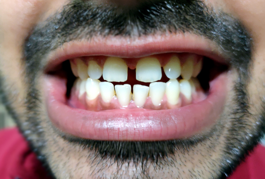 Do Clear Aligners Fix Crooked Teeth, Gaps & Overbites?