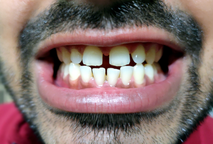 Do Clear Aligners Fix Crooked Teeth, Gaps & Overbites?