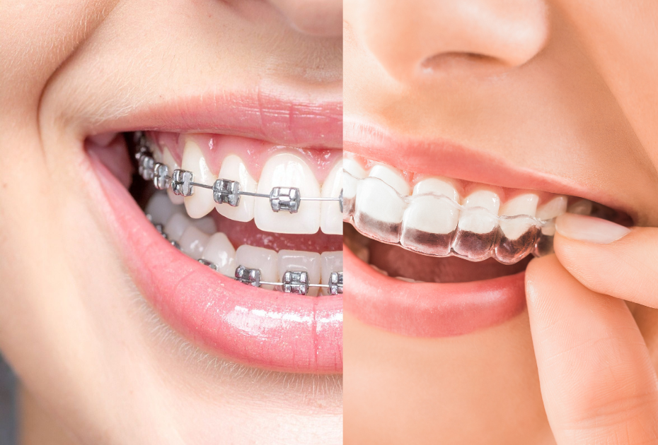 Invisible Braces vs. Clear Braces: What’s the Difference?