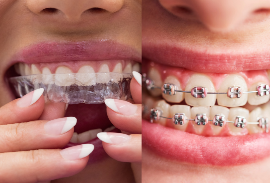 Clear Aligners vs Braces in New Zealand (2026): Cost, Comfort, and Daily Life Compared