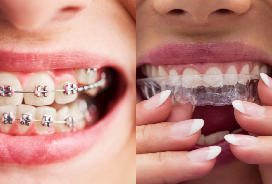 Clear Aligners vs Traditional Braces in New Zealand: Which Is Better?