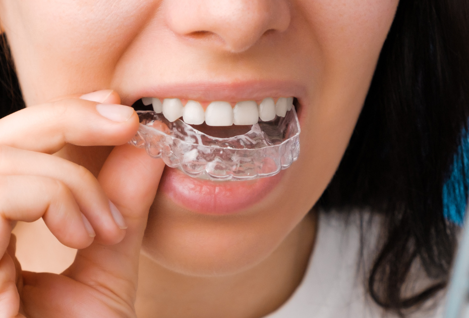 Do Clear Aligners Hurt? What NZ Patients Should Expect
