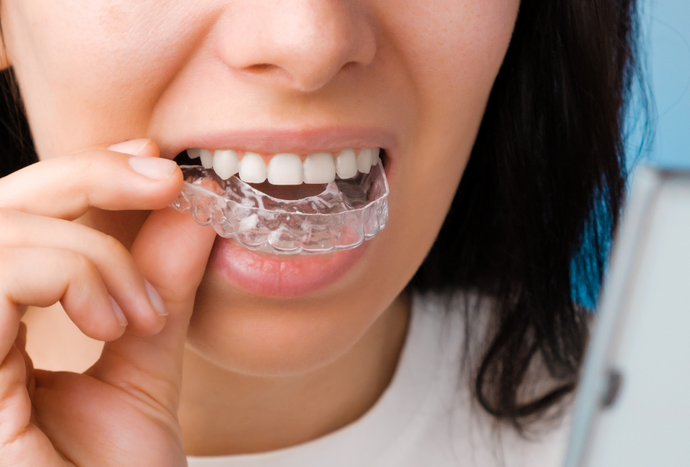Transparent Teeth Braces: How Do They Work and Are They Worth It?