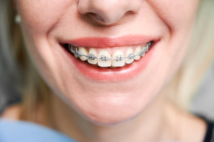Clear Aligners vs. Ceramic Braces: Best Option for Adults in NZ